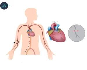 أنواع القسطرة القلبية و إستخداماتها 